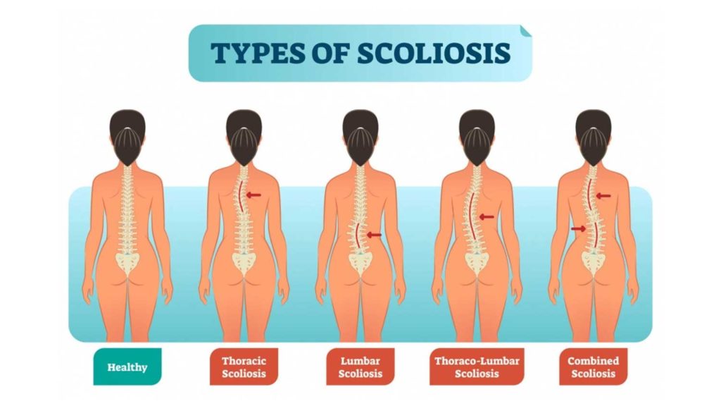 scoliosis ke prakaar