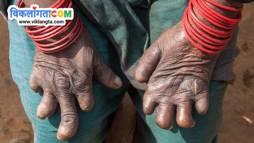 deformed hands of a leprosy cured woman in india
