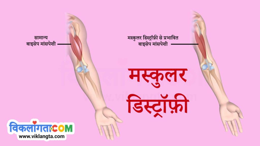 illustration showing muscle weakness in muscular dystrophy