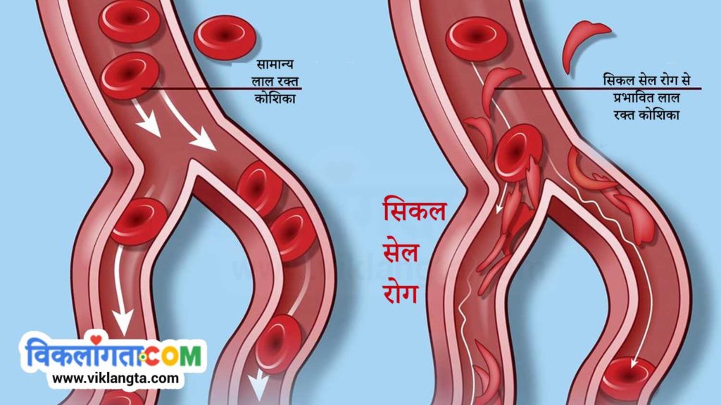 illustration showing red blood cells affected with sickle cell disease