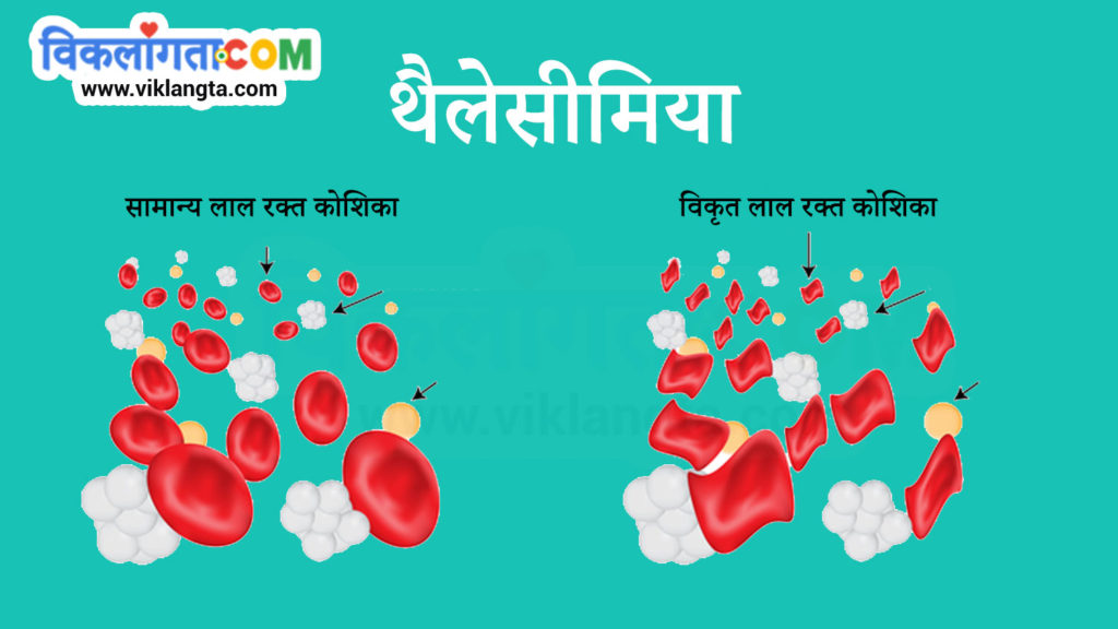 thalassemia image show normal and malformed red blood cells